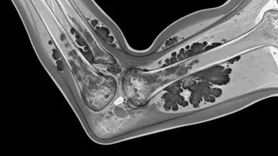 Sinovite vilonodular pigmentada do cotovelo