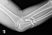 Fratura de olécrano