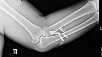 Fratura de olécrano