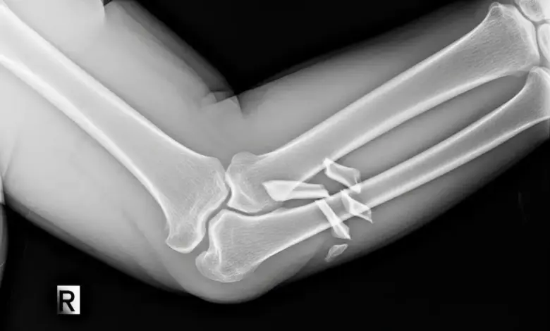 Fratura de olécrano