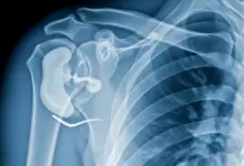 Osteonecrose da cabeça do úmero