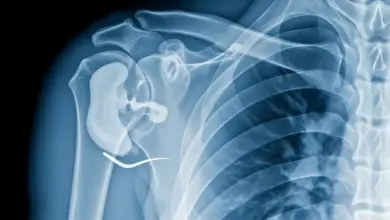 Osteonecrose da cabeça do úmero