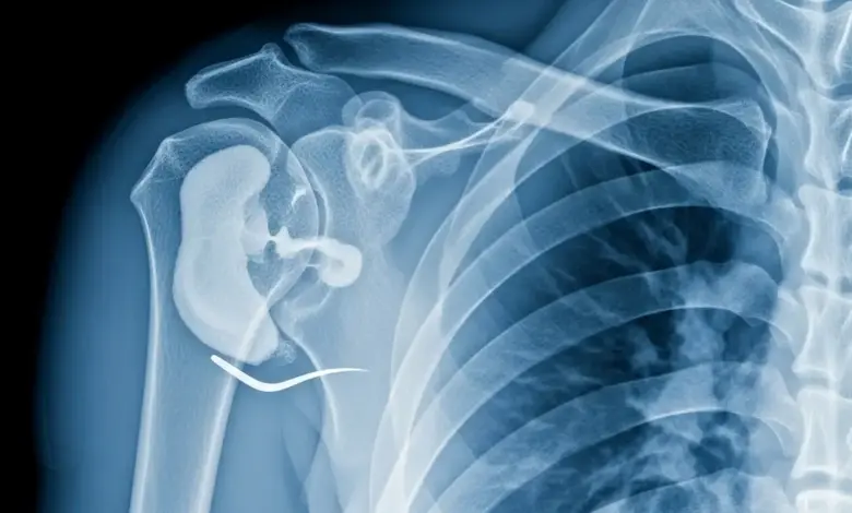 Osteonecrose da cabeça do úmero