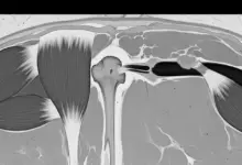 Ruptura do tendão distal do bíceps