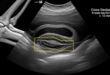 Síndrome do túnel cubital