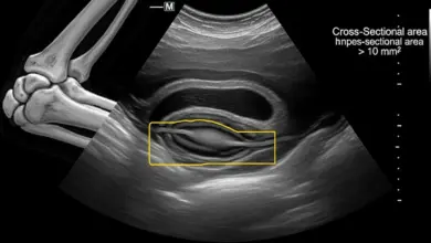Síndrome do túnel cubital