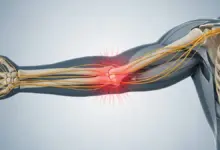 Dor no cotovelo esquerdo que irradia para a mão