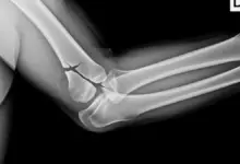 Fratura da cabeça do rádio