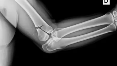 Fratura da cabeça do rádio