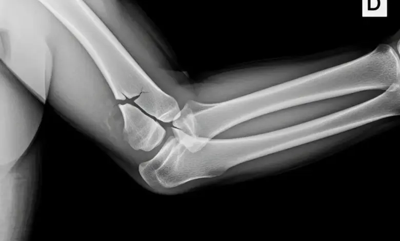 Fratura da cabeça do rádio