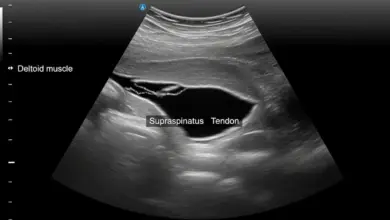 Por que lesionei o manguito rotador