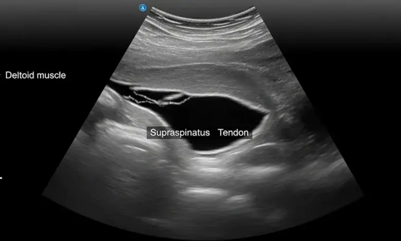 Por que lesionei o manguito rotador