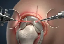 Tenotomia do bíceps por artroscopia