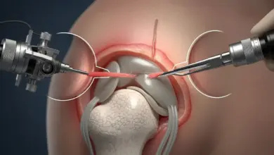 Tenotomia do bíceps por artroscopia