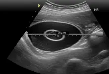 Cisto no ombro pode ser câncer