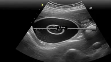 Cisto no ombro pode ser câncer