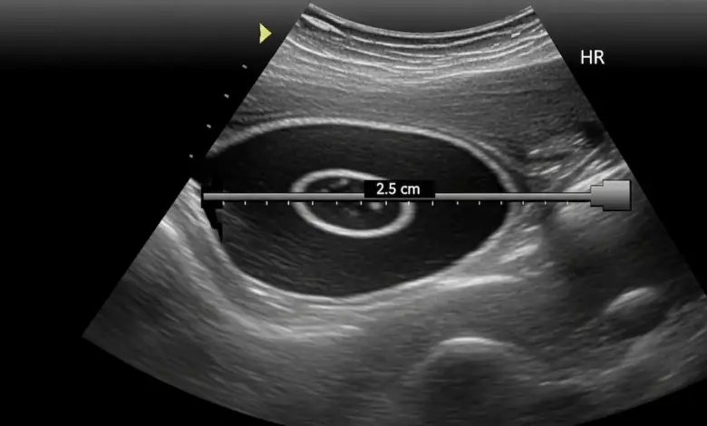 Cisto no ombro pode ser câncer