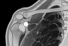 Cisto no ombro tem que operar