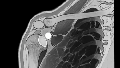 Cisto no ombro tem que operar