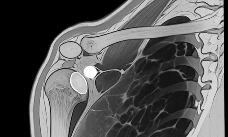 Cisto no ombro tem que operar