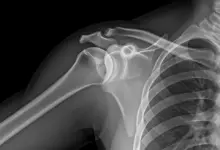 Clavícula saltada é normal