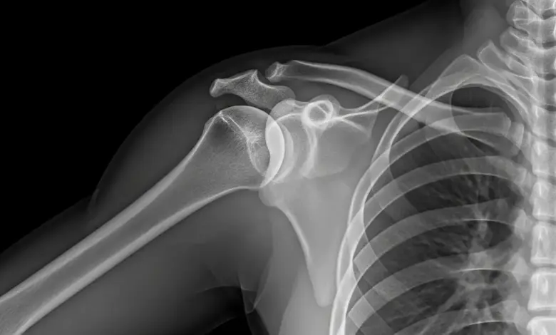 Clavícula saltada é normal