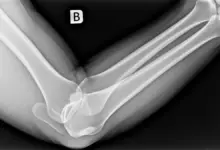 Como saber se desloquei o cotovelo