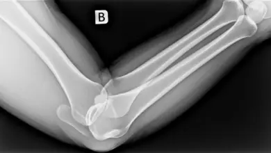 Como saber se desloquei o cotovelo