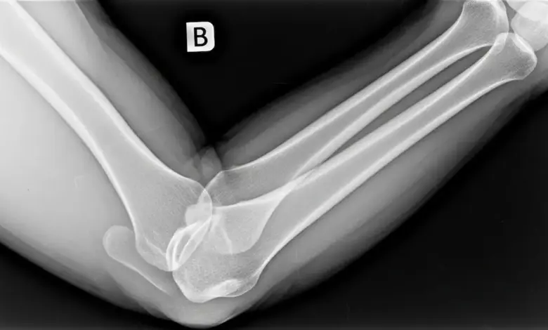 Como saber se desloquei o cotovelo