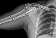 Fratura no ombro precisa de cirurgia