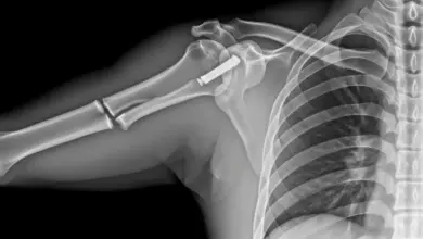 Fratura no ombro precisa de cirurgia