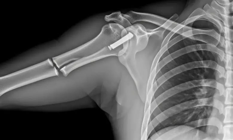 Fratura no ombro precisa de cirurgia