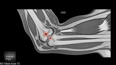 Lesão do ligamento ulnar colateral lateral do cotovelo