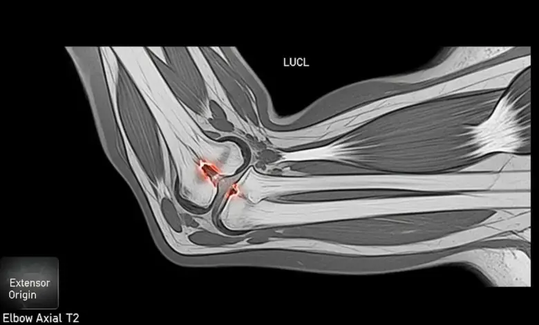 Lesão do ligamento ulnar colateral lateral do cotovelo