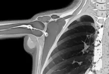 Ruptura completa do manguito rotador