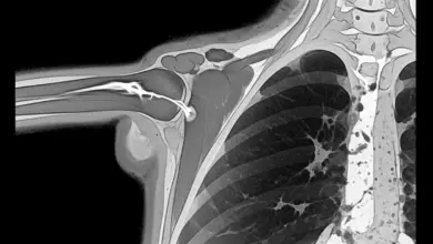 Ruptura completa do manguito rotador